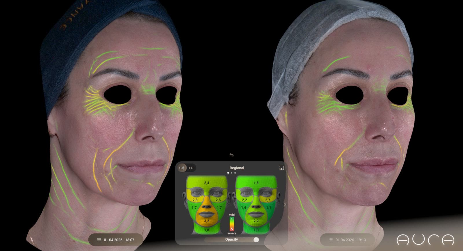 Rezultat Aura Reality 3D dijagnostike, mapa dubine bora preciznija od AI analize kože